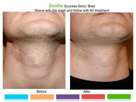 Soothe 2 Is Great To Prevent Redness And Bumps From Shaving