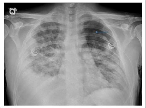 Bilateral Pulmonary Infiltrates On Chest X Ray Download Scientific