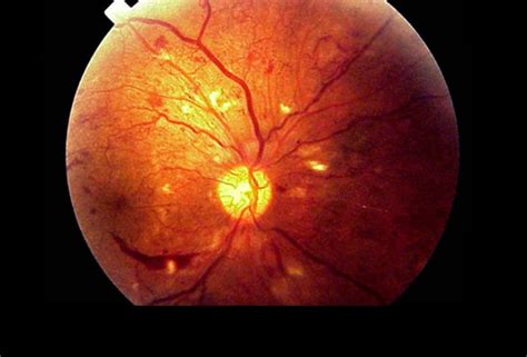 Retina Abnormalities 14 Signs Of Systemic Disease