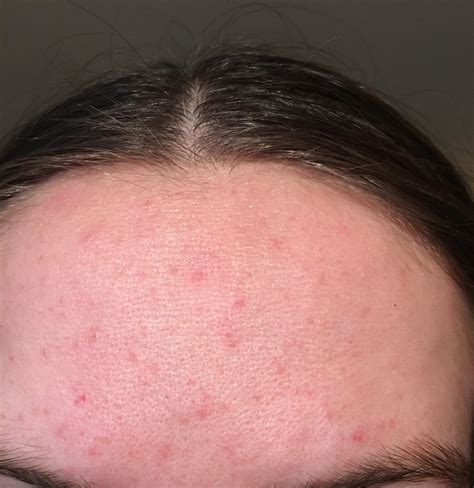 Skin Concerns Looking For Routine Advice Persistent Red Bumps On
