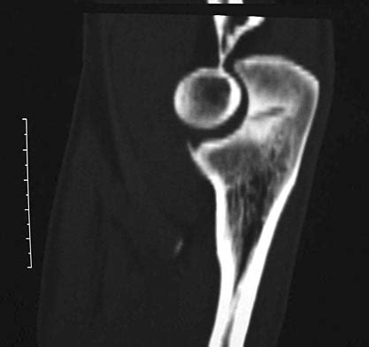 Olecranon Stress Fracture - Shoulder & Elbow - Orthobullets