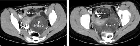Bilateral Mature Cystic Ovarian Teratoma Radiology Cases
