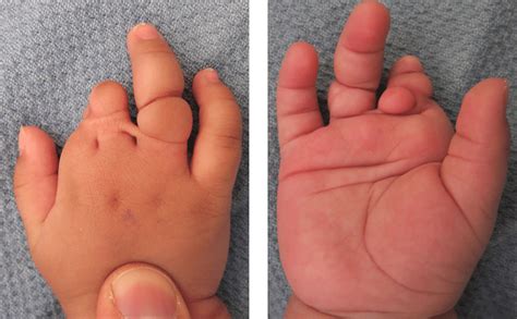 Dorsal A And Palmar B Views Of A Hand With Amniotic Constriction
