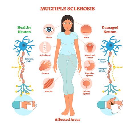 Multiple sclerosis (ms) is a condition that can affect the brain and spinal cord, causing a wide range of potential symptoms, including problems with vision, arm or leg movement, sensation or balance. Esclerosis múltiple ¿cómo ayuda la quiropráctica? - Natural Spine