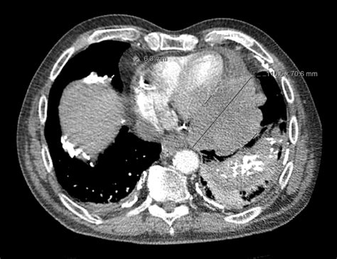 Cureus Primary Pericardial Mesothelioma A Rare But Serious Consideration