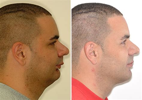 Case 7 Lower Jaw Surgery And Genioplasty Sydney Oral And Facial Surgery