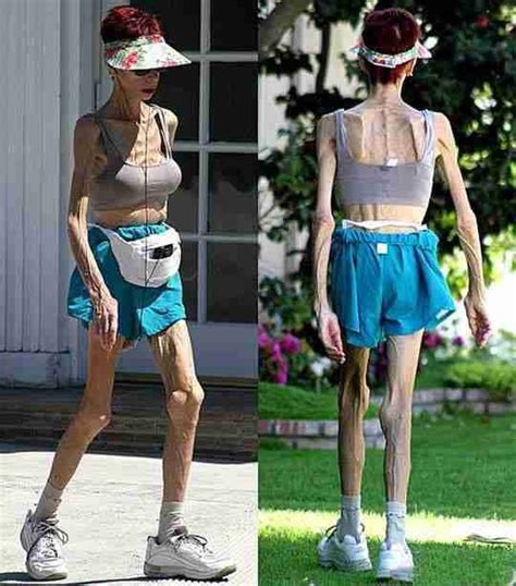Anorexia Helping An Anorexic Person