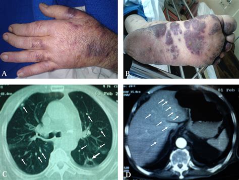 Pulmonary And Cutaneous Nodules In An Immunocompromised Patient Thorax