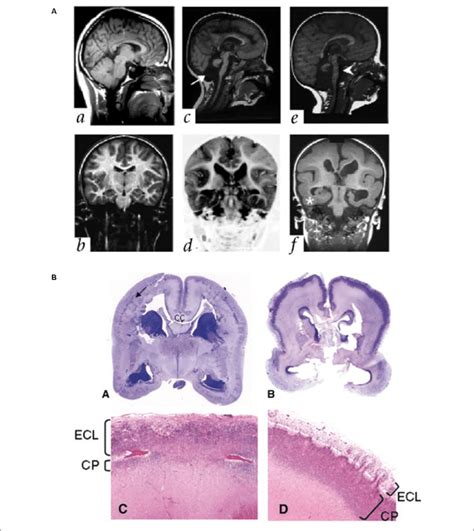 Lissencephaly In Patients With Mutations In Ecm And Ecm Associated