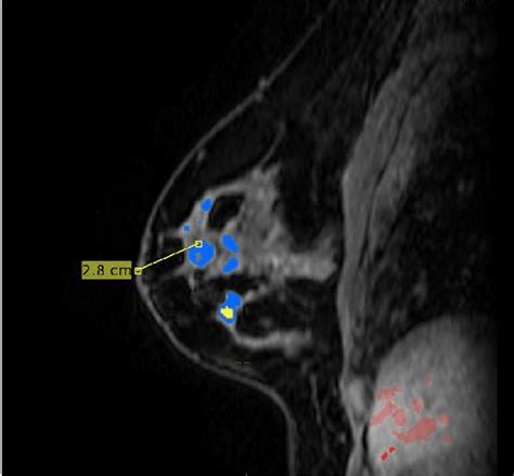 Cureus Adenoid Cystic Carcinoma Of The Breast Two Case Reports