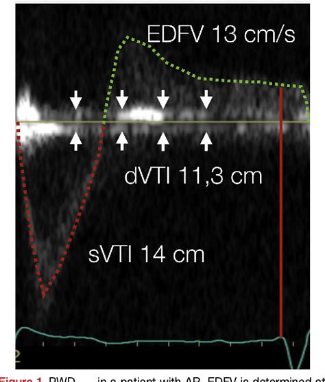 Figure 1 From Pulsed‐wave Doppler Recordings In The Proximal Descending