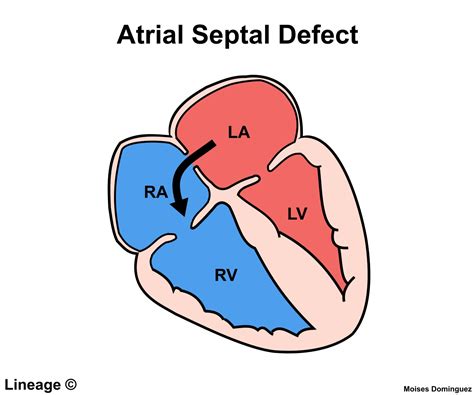 Atrial Septal Defects Cardiovascular Medbullets Step 1