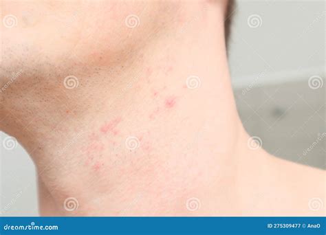 Skin Irritation On Male Neck After Shaving Close Up Photo Stock Image