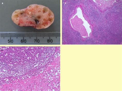Lymph Node Pathology In The Hiv Positive Child Diagnostic Histopathology