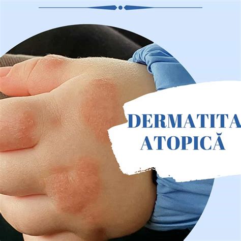 Dermatita atopică e medicina md