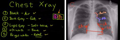 Chest X Ray Interpretation Made Easy Learn To Read A Cxr