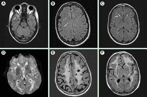 Brain Mri Abnormalities In Cerebral Autosomal Dominant Arteriopathy