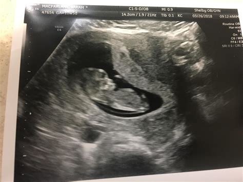 11 Weeks Pregnant Ultrasound Symptoms Belly