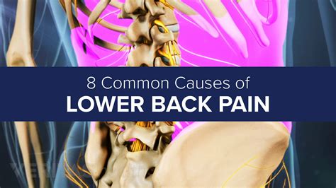 Slideshow 8 Common Causes Of Lower Back Pain Spine Health