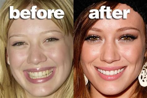 Hilary Duff Teeth Transformation With Veneers