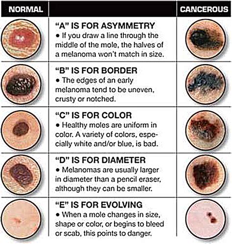 Skin Cancer Stage 2 Cancerwalls