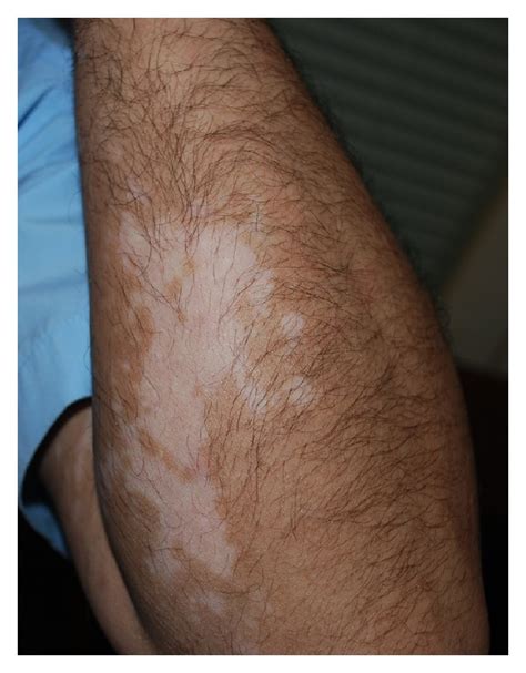 Vitiligo Patches On Left Arm Distant From The Location Of Dpcp