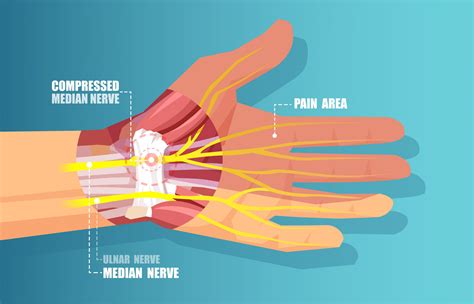 Wrist Ligaments Diagram