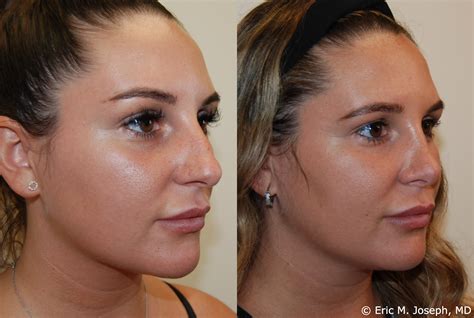Eric M Joseph Md Rhinoplasty Before And After Profile Bump And