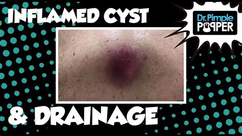 Inflamed Cyst Incision And Drainage Pimple Popping Cysts Comedone