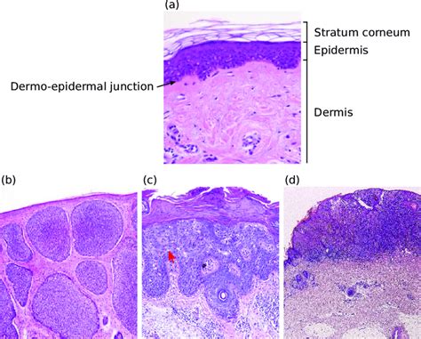 Squamous Cell Carcinoma Vs Basal Cell Carcinoma Histology