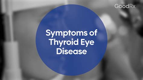 Symptoms Of Thyroid Eye Disease Graves Orbitopathy Goodrx