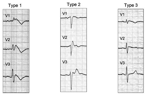 Brugada Syndrome Electrocardiogram Wikidoc