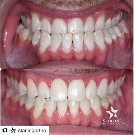 Severe Underbite Corrected With Orthognathic Surgery By Omsnashville