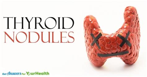 Are Thyroid Nodules A Concern Health Solutions Plus