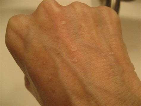Chemical Peels For Acne And Anti Aging Hand Age Spots Treated With Tca