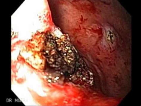 What does it mean to dream about your child getting shot? Video Clip An Endoscopy of A Stomach Cancer