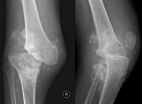 Charcot Osteoarthropathy Of The Knee Secondary To Neurosyphilis A Rare