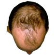 The main difference between hair breakage and hair loss is hair breakage will result in short pieces of hair. Hair Weaving in Bangalore - Delhi NCR | Permanent Hair ...