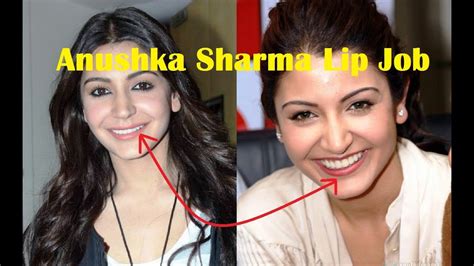 Anushka Sharma Plastic Surgery Before After Disaster