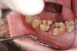 If a wisdom tooth is troublesome, the following symptoms might include swelling and ache of the gum overlying the teeth. What causes bad breath - Caring 4 Smiles
