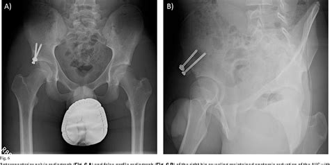 Figure 1 From Operative Fixation Of An Anterior Inferior Iliac Spine