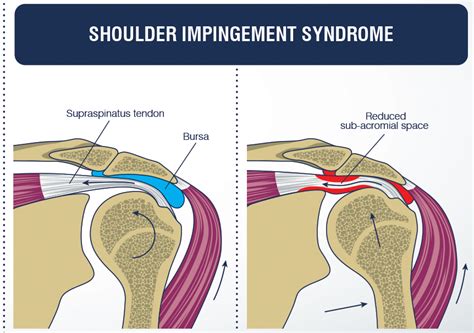 Bolečina v ramenu spredaj ukleščitev ramena ali subakromialna