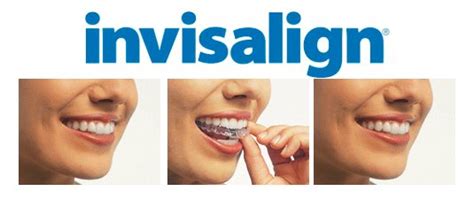 The less aligned they are, the more trays you'll need to adjust your bite. Invisalign Austin, Invisalign Express Starting at $2800