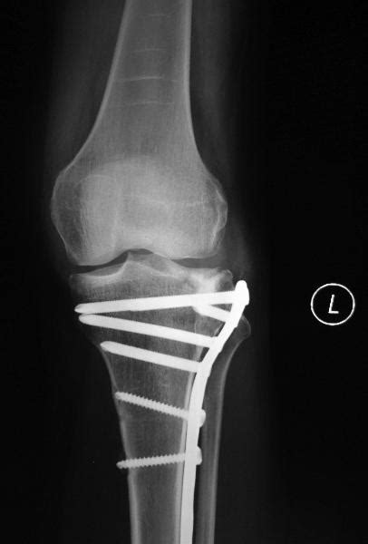 Tibial Plateau Fracture Using Arthroscopy To Help Obtain Good Result