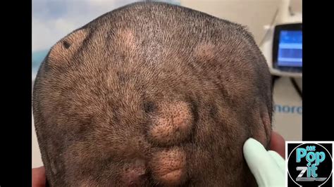 Pilar Cyst 11 Only A Few Left On His Scalp Cyst Pops Out Of Its