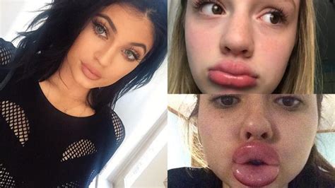 Kylie Jenner Lip Challenge “pout” Of Control Etched In Stone