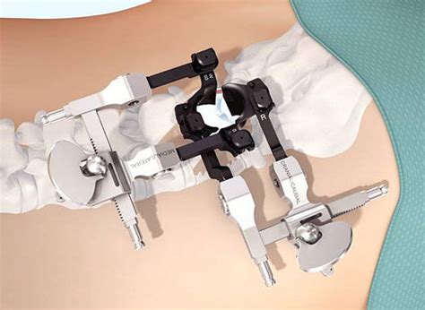 Spinal Retractor Insight Depuy Synthes Orthopedic Surgery For