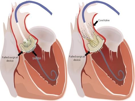 Valve In Valve Tavr Success May Depend On Surgical Factors