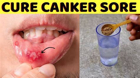 In 24 Hours Get Rid Of A Canker Sore Overnight And Fast In Your Tongue
