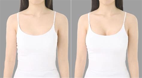 Липофилинг грудных желез Фото до и после операции по увеличению груди собственным жиром